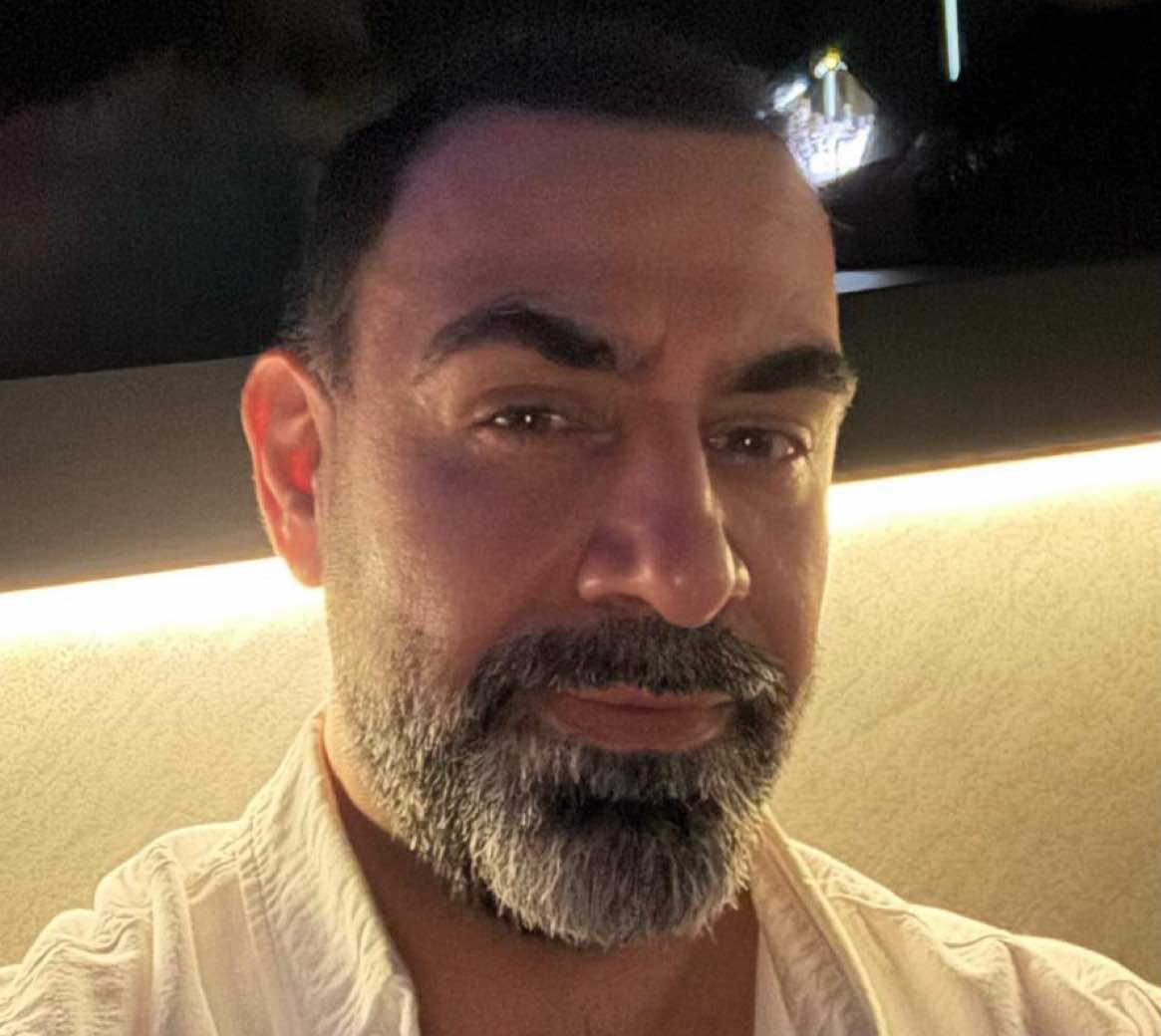 after: Botox for Glabellar Lines (Angry 11's)