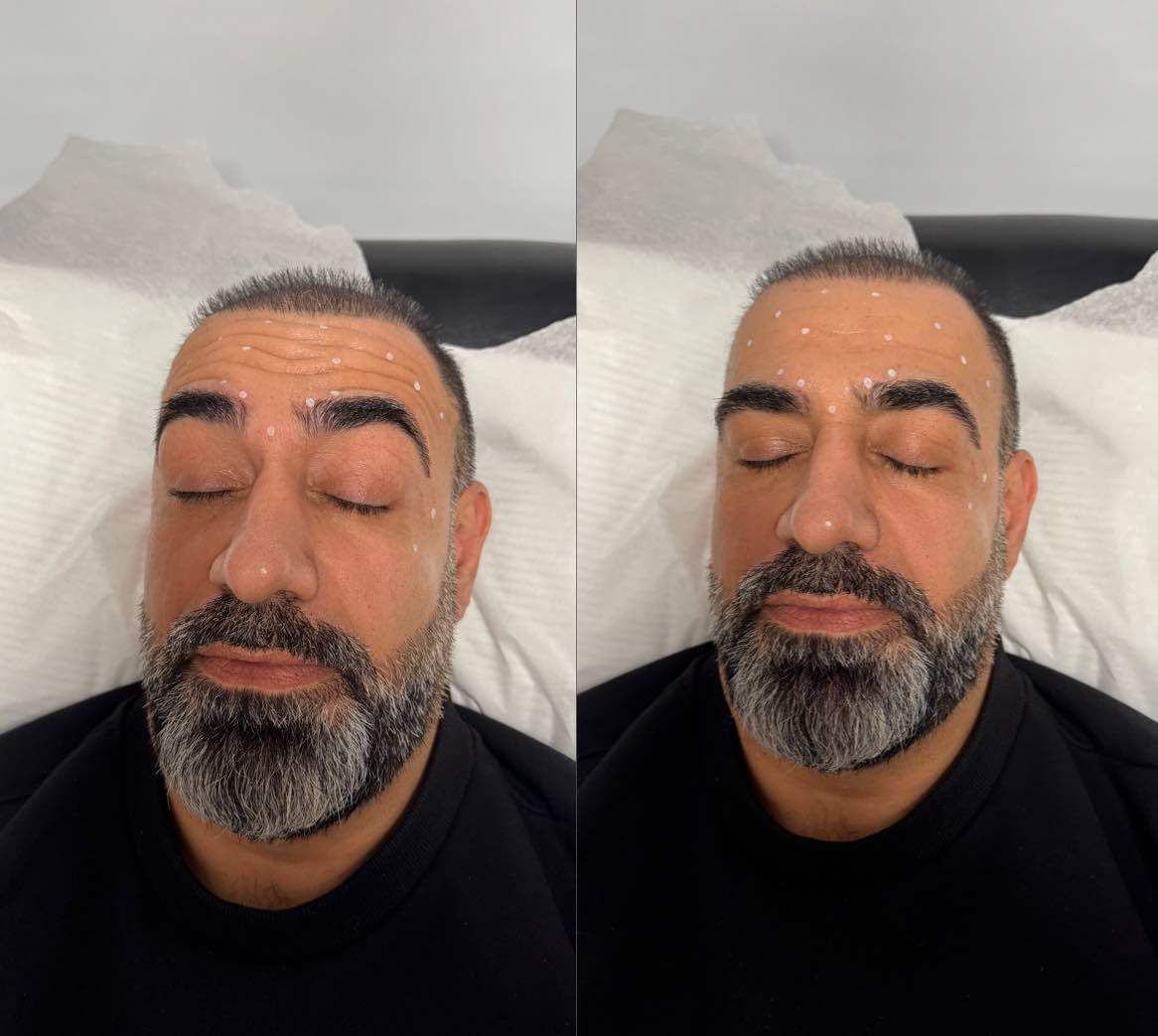 before: Botox for Glabellar Lines (Angry 11's)