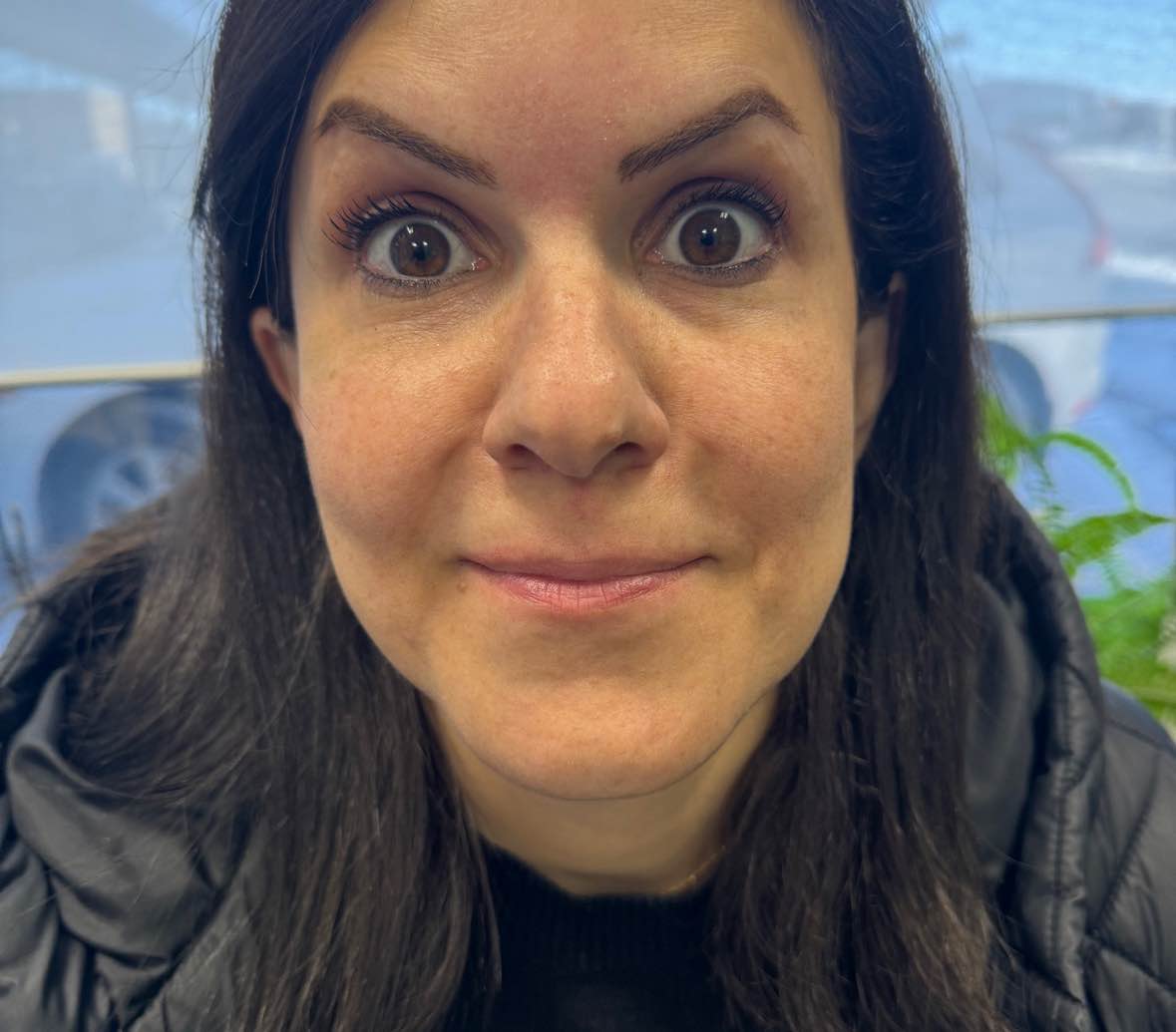 after: Botox for Brow Lift
