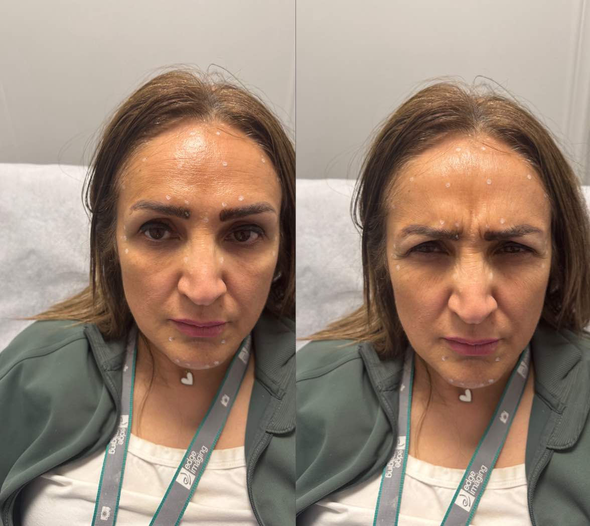before: Botox for Frown lines