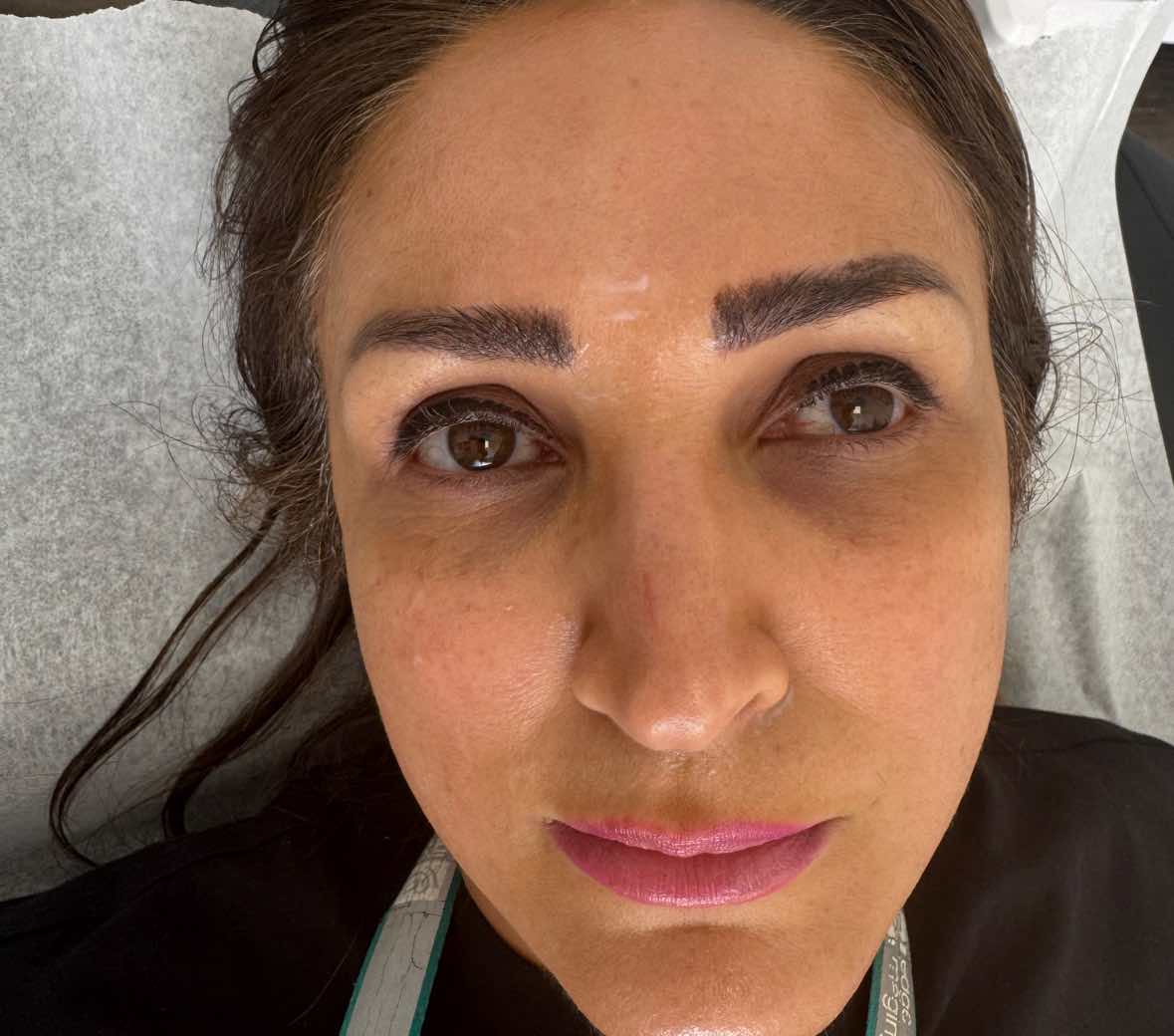 after: Botox for Frown lines