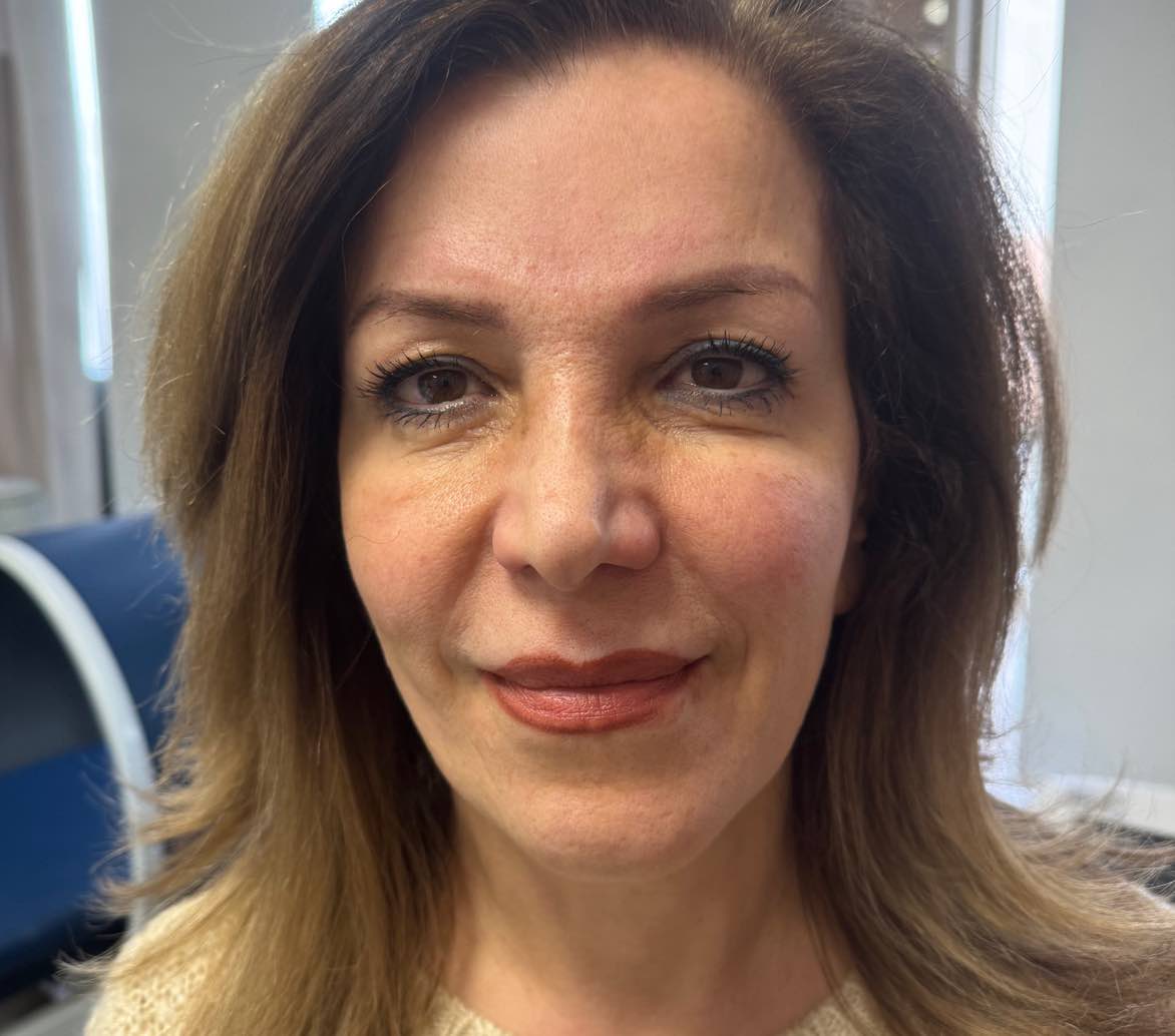 after: Botox for Crow's Feet