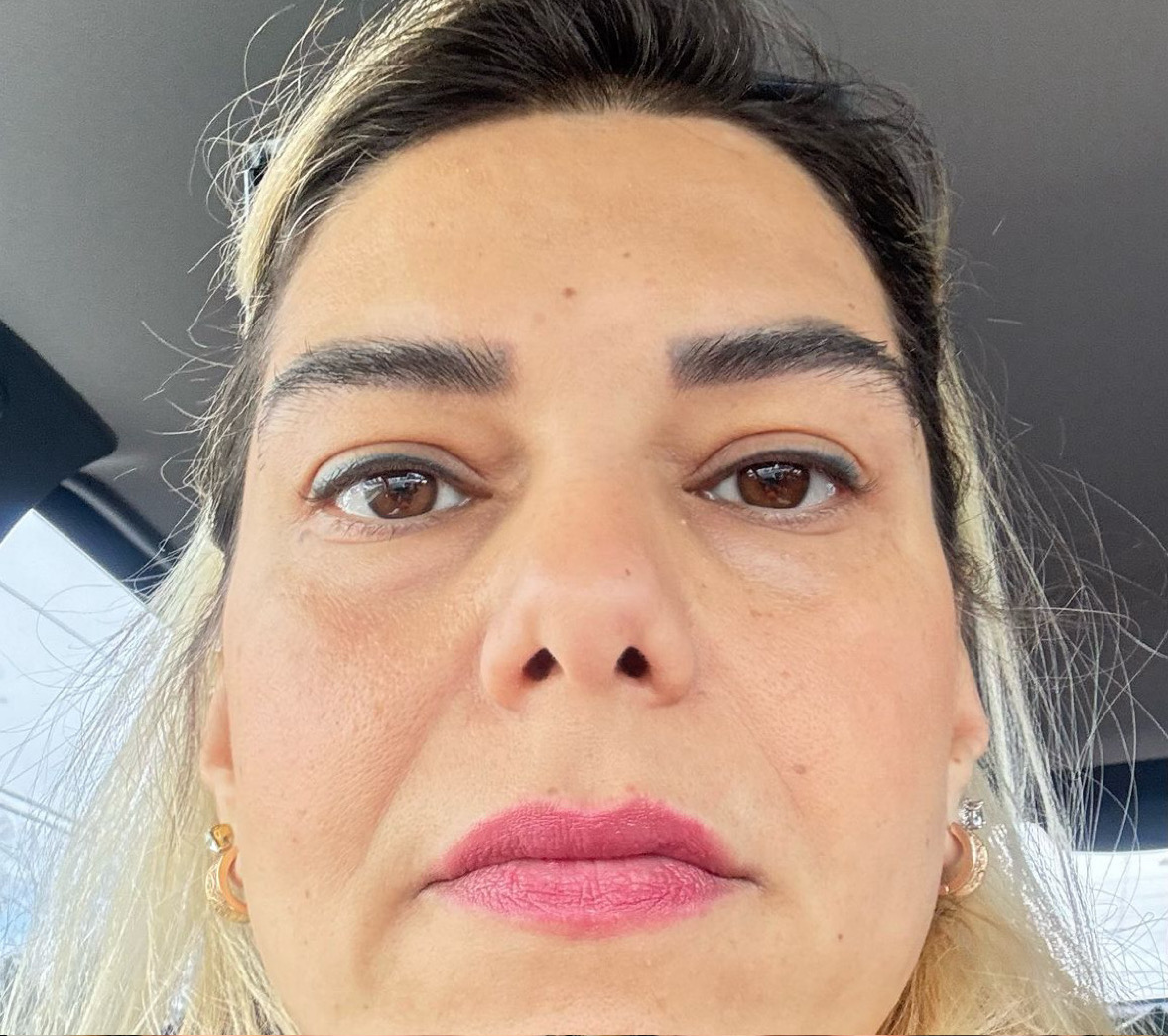 after: Botox for Crow's Feet