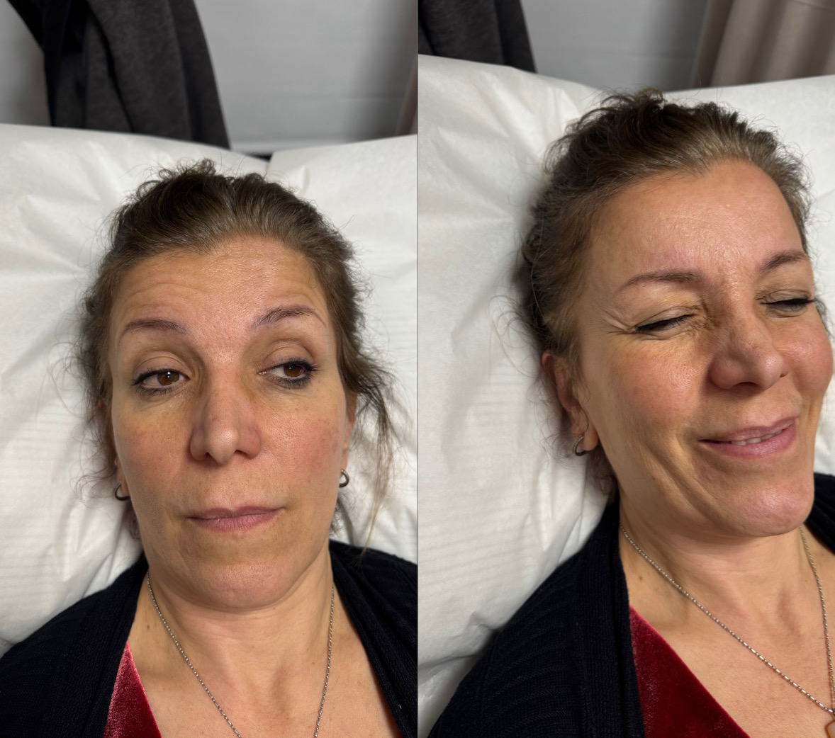 before: Botox for Crow's Feet