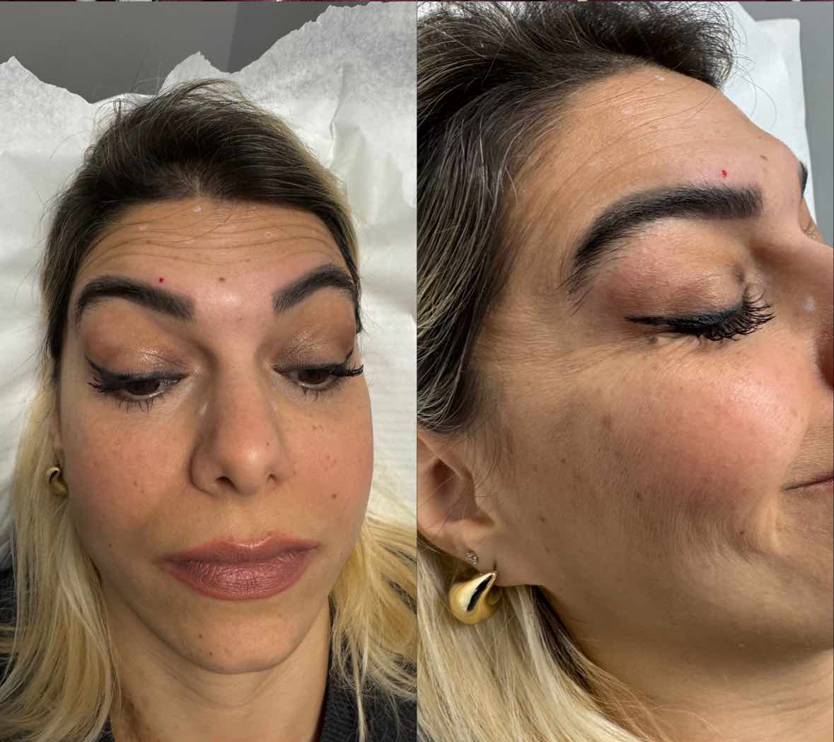 before: Botox for Crow's Feet