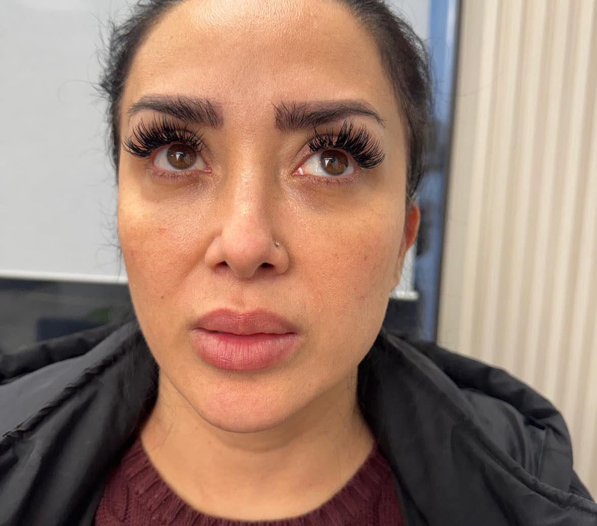 after: Botox for Crow's Feet