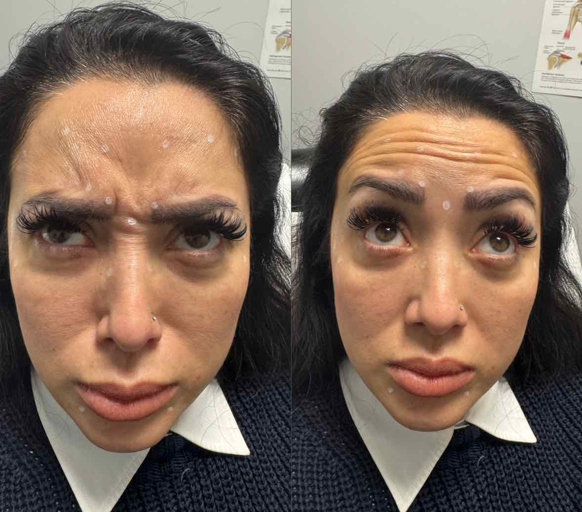 before: Botox for Crow's Feet