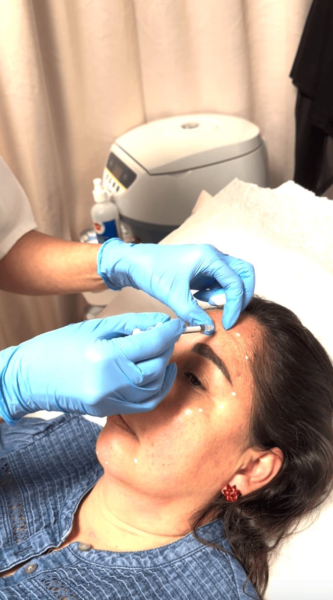 botox injection